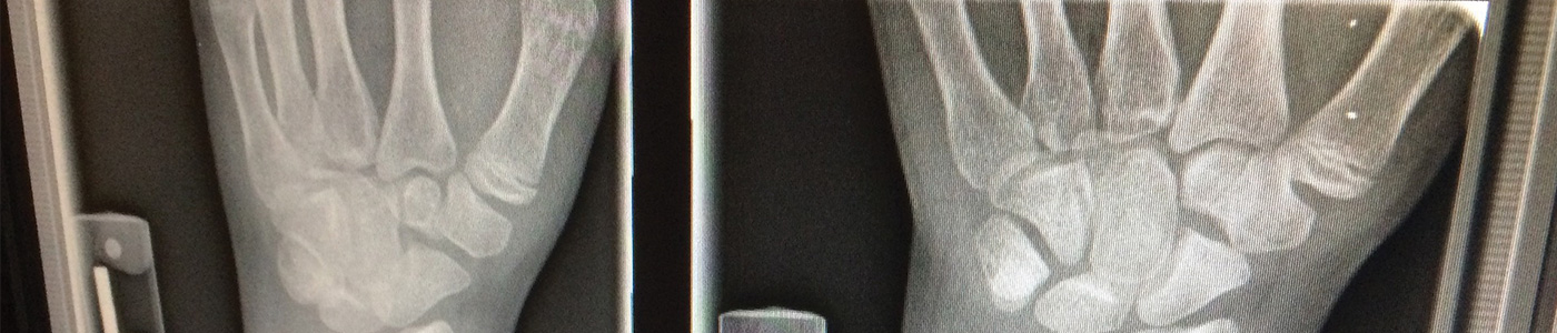 Mitigating Prime Contractors' Liability for Injuries to Subcontractors' Employees