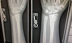 Mitigating Prime Contractors' Liability for Injuries to Subcontractors' Employees